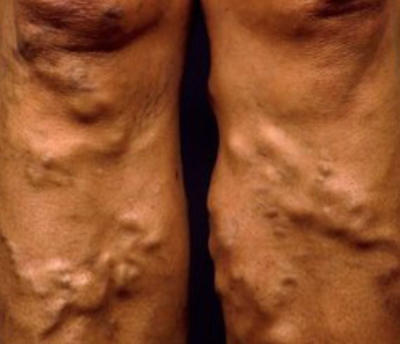 Varicose Vein